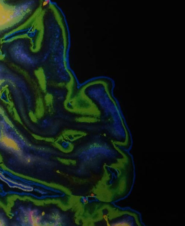 The Economic and Societal Cost of Alzheimer's Disease in Australia